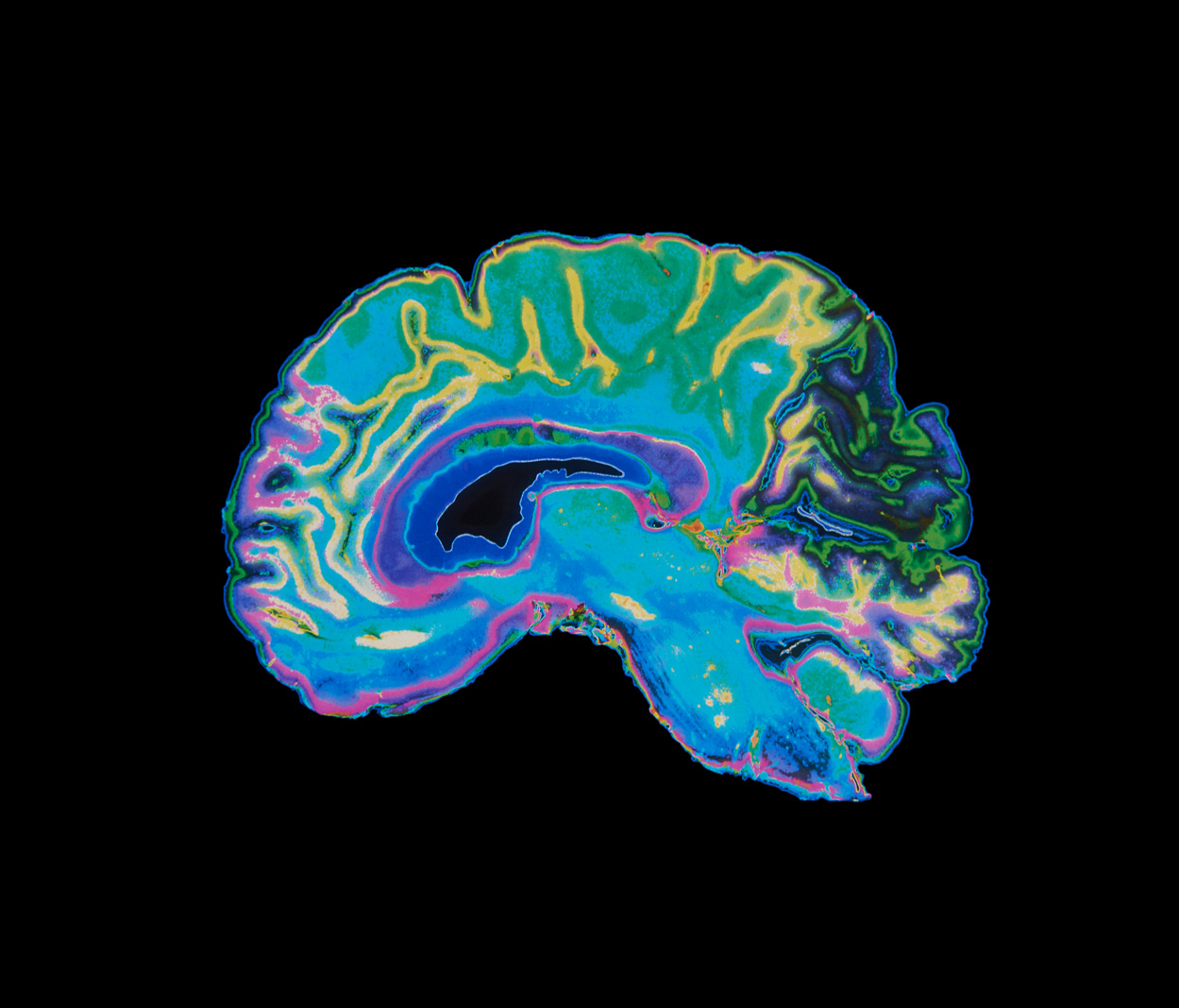 Colorful sagittal brain scan visualization with rainbow heatmap overlay in blue, green, yellow, pink, and purple tones, representing functional or structural brain imaging data