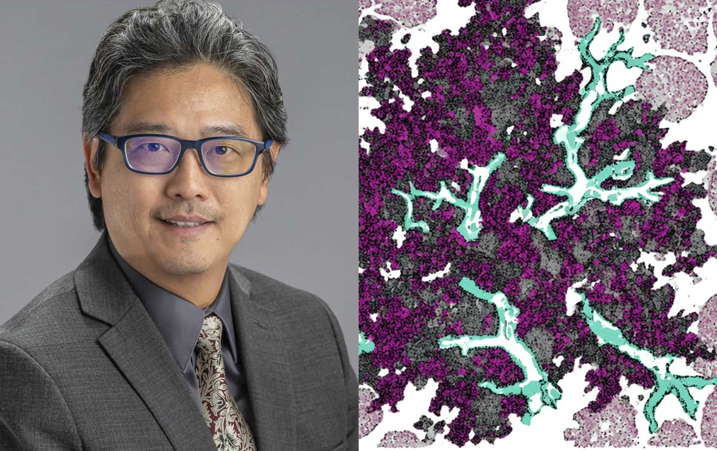 Side-by-side composite: Professional portrait of Dr. Jun Zhang, MD, PhD (left), wearing glasses and a suit, next to a colorful microscopic pathology image of lung cancer tissue stained in purple, black, and teal highlighting cellular structures and potential biomarkers (right).